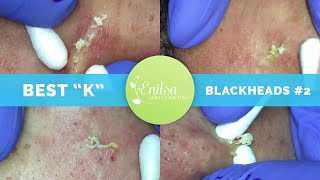 quotKsquot Best Blackhead Extraction Compilation Part 2 [upl. by Nylzor]