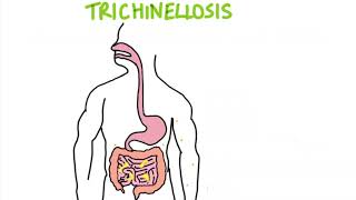 Trichinellosis  Presentation Diagnosis Treatment USMLE PLAB [upl. by Adnoved797]