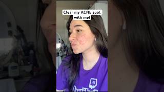 Clear my acne with me🤌 acne skin skincare skincareroutine shorts clearskin [upl. by Yajet]