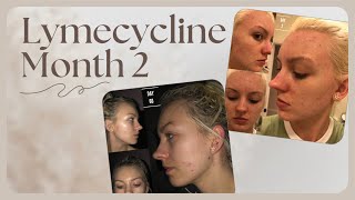 ACNE MONTH 2 ON LYMECYCLINE [upl. by Brittney]