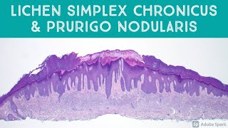 Lichen Simplex Chronicus amp Prurigo Nodularis The quotLichenquot Every Pathologist Should Know [upl. by Lundeen836]