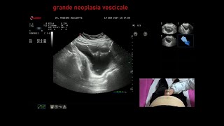 grande neoplasia della vescica [upl. by Mitchel]