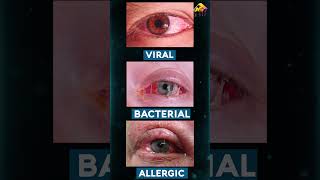 लाल आँख  How to treat Conjunctivitis or Pink Eye 3D Animation by Armature Studios [upl. by Wing]