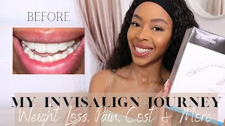 MY INVISALIGN JOURNEY  WEIGHT LOSS COST PAIN AND THE PROCESS [upl. by Tdnarb]