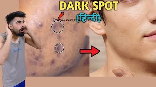 How To Remove DARK SPOTS From Face Naturally  Mridul Madhok [upl. by Aihsenal]