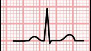 ECG Interpretation  Time and the ECG Section 1 Part 5 [upl. by Sixele]