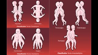 Types of conjoined conjoint twins  Omphalopagus Pygopagus Craniopagus Diprosopus Parapagus [upl. by Angrist]