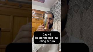 Restoring Hair Line Day5 using serum hairregrowth haircareroutine [upl. by Bronk]