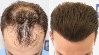 FUE Hair Transplant 3052 Grafts NW IIIVI Vertex By Dr Juan Couto  FUEXPERT CLINIC Madrid Spain [upl. by Northrop]