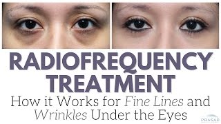 How Radiofrequency Devices Work on Fine Lines and Wrinkles and Why its Not the Only Treatment [upl. by Drucie]