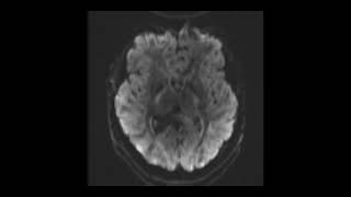 MRI BRAIN TBI Set 7 [upl. by Nelly]