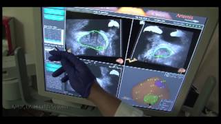 11 MRUS Fusion Guided Prostate Biopsies Technical Discussion [upl. by Awram]