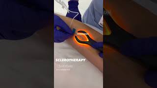 Instant Results with Sclerotherapy for Spider Veins  EDEN AESTHETICS Clinic Dubai [upl. by Hsiri934]