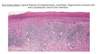 Lecture43 Lichen Planus and Lichenoid disorders Rooks chapter 37 [upl. by Cristiona]