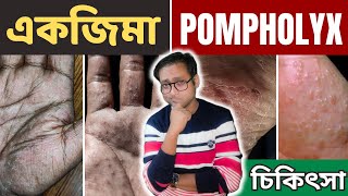 Dyshidrotic eczema  Pompholyx  চিকিৎসা  Dr Supratim Saha [upl. by Persas74]