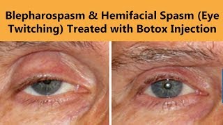 Botox Injection for Blepharospasm amp Hemifacial Spasm Eyelid Twitching  The Esthetic Clinics [upl. by Charbonnier]