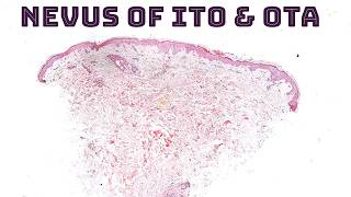 Nevus of Ito Ota Sun Hori amp Dermal Melanocytosis quotMongolian Spotquot under the microscope dermpath [upl. by Alli]