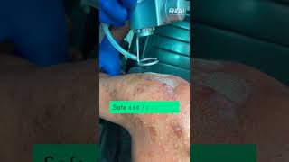 LASER TREATMENT FOR KELOID [upl. by Maurice]