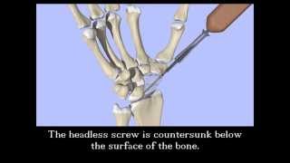 Scaphoid Fracture Screw Fixation [upl. by Ianahs]