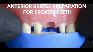 Dental Bridge Preparation after Tooth Extraction [upl. by Campman]