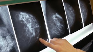 New drug Trodelvy offers hope for breast cancer patients [upl. by Arraek]