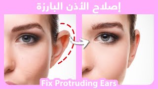 Fix Protruding Ears NATURALLY  إصلاح الأذن البارزة بشكل طبيعي [upl. by Elvah981]