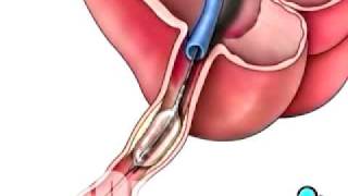 PreOp® Patient Education Balloon Angioplasty Coronary [upl. by Congdon]