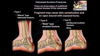 Calcaneal Avulsion Fractures  Everything You Need To Know  Dr Nabil Ebraheim [upl. by Eldnek704]