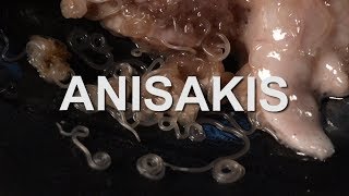 Anisakis [upl. by Ative]