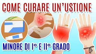 COME CURARE LE USTIONI [upl. by Htebzil]