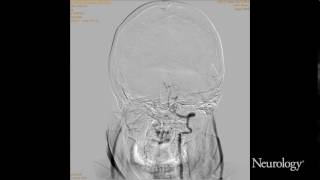 Rupture of vertebral artery dissection aneurysm during 3D DSA [upl. by Ardnnaed]