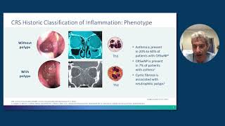 Rhinosinusitis With Nasal Polyps From Pathophysiology to Management [upl. by Ennayr]