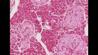 Histopathology Pancreas Type 2 Diabetes mellitus [upl. by Stanly213]