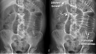 X ray of Small Bowel Obstruction [upl. by Rabiah]