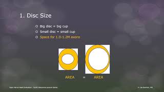 Optic Nerve Head Evaluation by Dr Hannah de Guzman [upl. by Naugan]