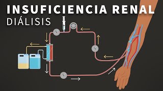 Insuficiencia Renal Terminal y Dialisis [upl. by Swithbert]