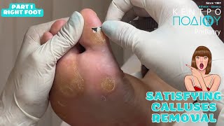 Satisfying Calluses Removal 1Αφαίρεση κάλωνΚέντρο Ποδιού PodiatryPodiatrist κεντροποδιου corn [upl. by Akirdnas]