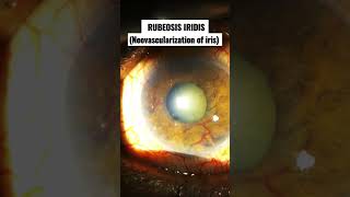 RUBEOSIS IRIDIS Ie Neovascularization of iris [upl. by Willabella]