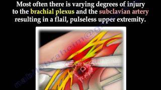 Scapulothoracic Dissociation  Everything You Need To Know  Dr Nabil Ebraheim [upl. by Thacker929]