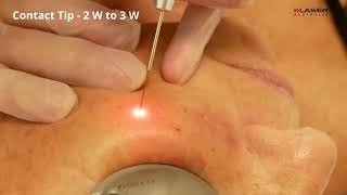 KLaser Blue Derma  Milia Laser treatment  Carly Whytcross [upl. by Atirys473]