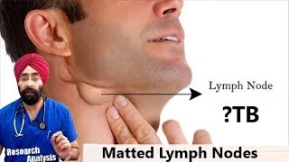 Matted Lymph Nodes क्या होता है  Lymphadenopathy  TB  DrEducation Hindi [upl. by Alekahs836]