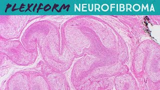 SchwannomaNeurilemmomaWhat are the symptoms and what causes schwannomakey factsusmleneetpgplab [upl. by Yllom]