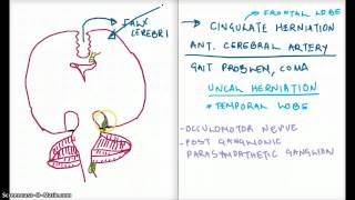 Easy Ways to Remember Cerebral Herniation [upl. by Halfdan]