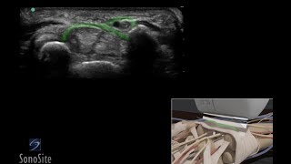 How To Wrist  Median Nerve Entrapment 3D Video [upl. by Oiziruam]