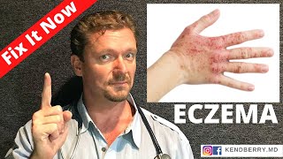 ECZEMA Improve or Reverse Your Eczema NOW 2024 [upl. by Huggins547]