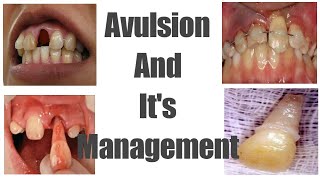 Avulsion  Avulsed tooth  Management  Treatment [upl. by Pepillo]