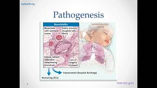 Bronchiolitis 8 31 24 [upl. by Lliw582]