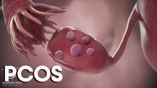 menstruation and Polycystic Ovary Syndrome or PCOS  Causes TreatmentsDandelion Medical Animation [upl. by Anelahs652]