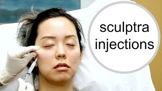 NON SURGICAL FACELIFT FOR JOWLS USING SCULPTRA INJECTIONS [upl. by Breed]