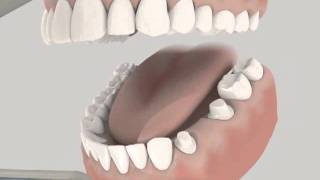 Dental Bridge animation [upl. by Yerggoeg]